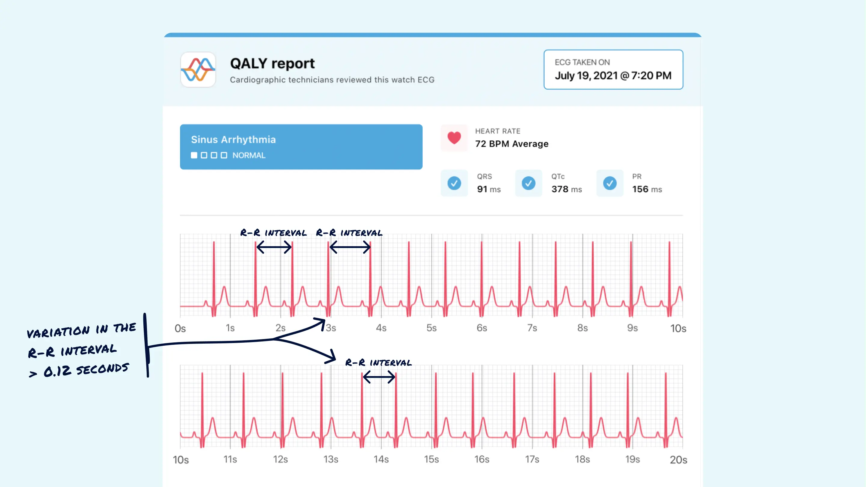 What Sinus Arrhythmia Looks Like on Your Watch ECG Qaly